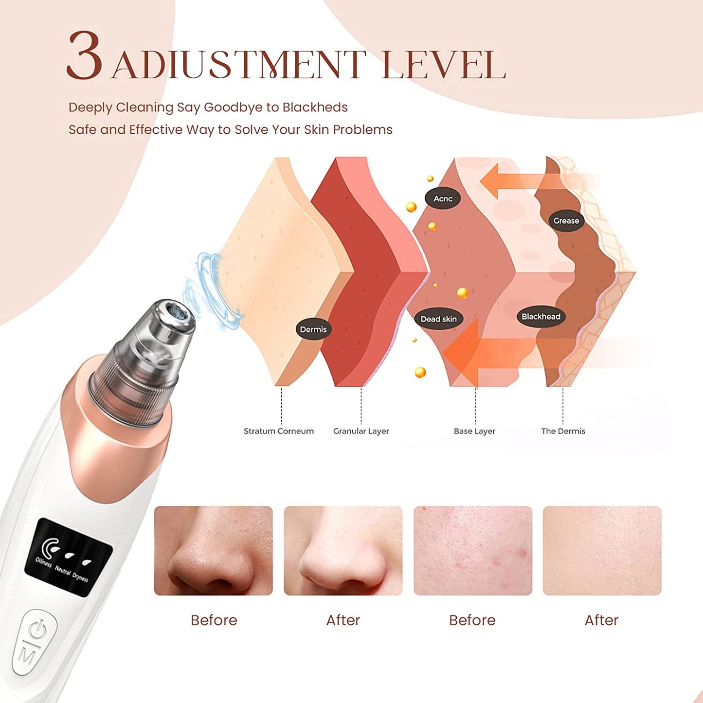 2024 Advanced Blackhead Remover Pore Vacuum - 5 Suction Levels, 5 Probes, USB Rechargeable Acne Extractor Tool for Flawless Skin (White)